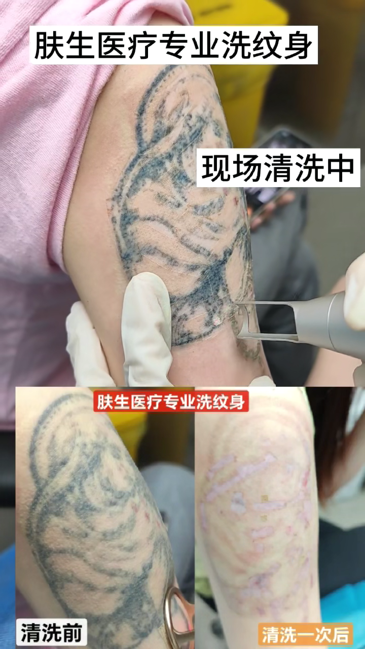 二手纹身，在整形医院清洗两次后，疤痕增生案